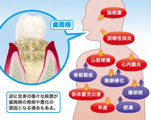 歯周病と全身疾患