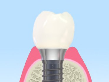 インプラント