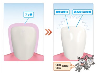 フッ素塗布